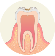 歯の表面に虫歯ができます