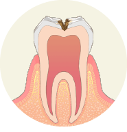 虫歯が神経に近くなり、冷たいものがしみます