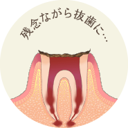 神経が死んでしまい、痛みを感じなくなります