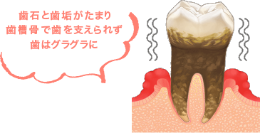 歯石と歯垢がたまり歯槽骨で歯を支えられず歯はグラグラに