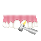 歯間や歯面をクリーニング