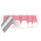 歯の表面をツルツルに仕上げ磨き